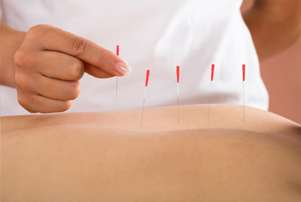 Dry Needling and Cupping Therapy